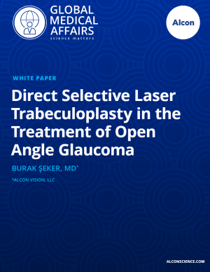 Direct Selective Laser Trabeculoplasty in the Treatment of Open Angle Glaucoma