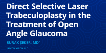 Direct Selective Laser Trabeculoplasty in the Treatment of Open Angle Glaucoma